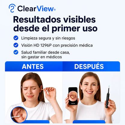 Limpiador Inteligente de Oídos con Cámara HD ClearView®
